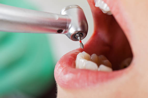 Best Emergency Root Canal Treatment in Ovilla, TX